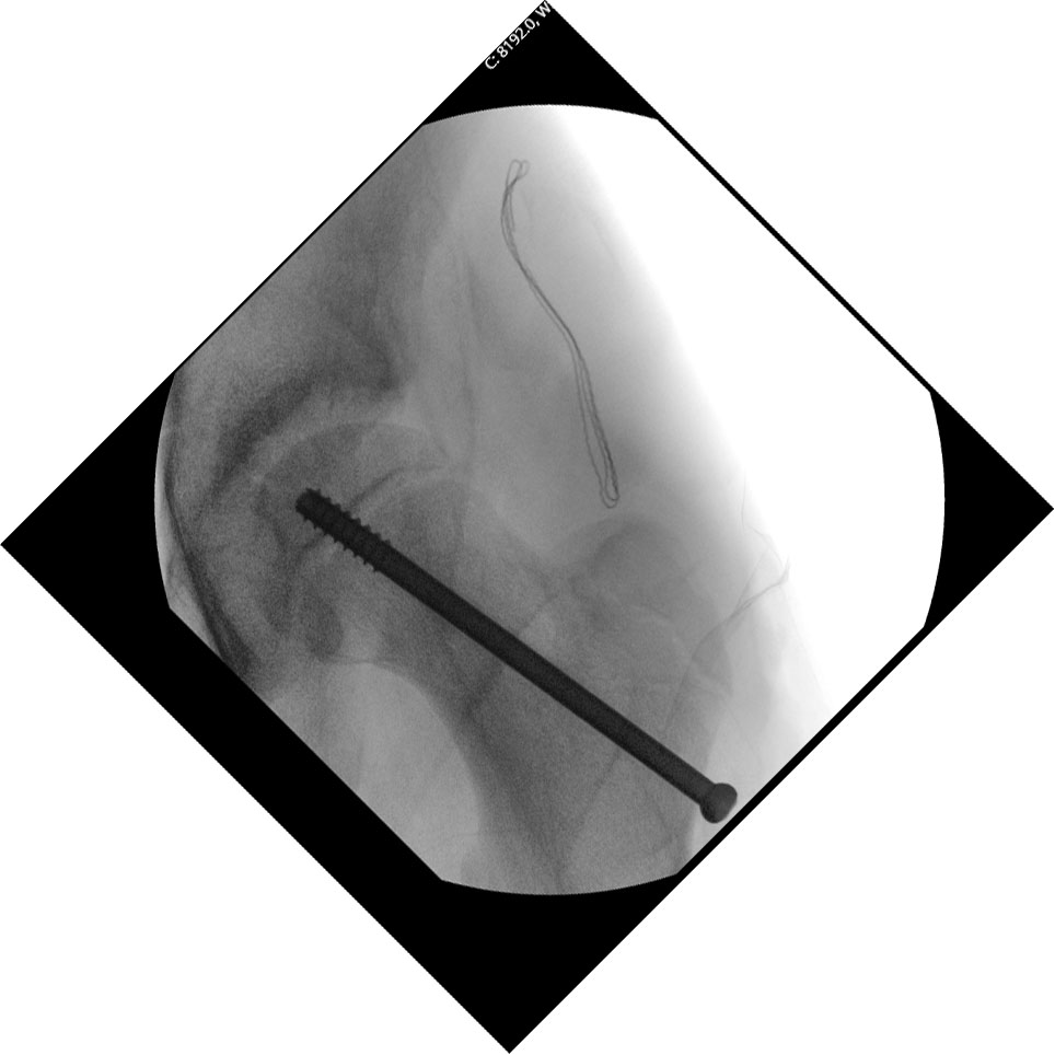 SCTE post OP