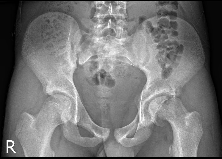 SCFE pre OP